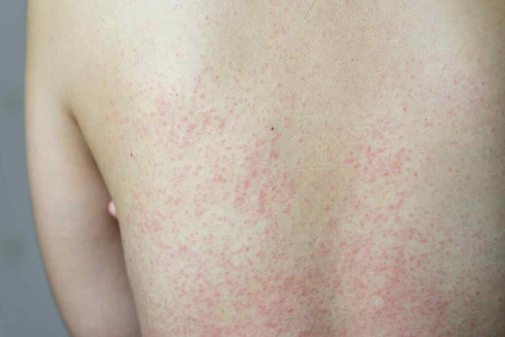 Colitus Rash Stress bij Colitis Ulcerosa en de Ziekte van Crohn | ibddebaas.nl